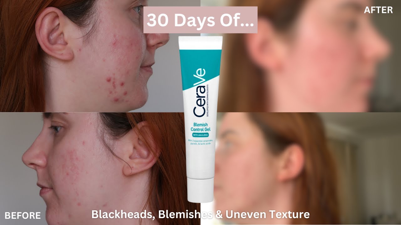 Blemish Control Gel | For clear, blemish-free skin