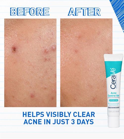 Acne Control Gel | For intense acne control