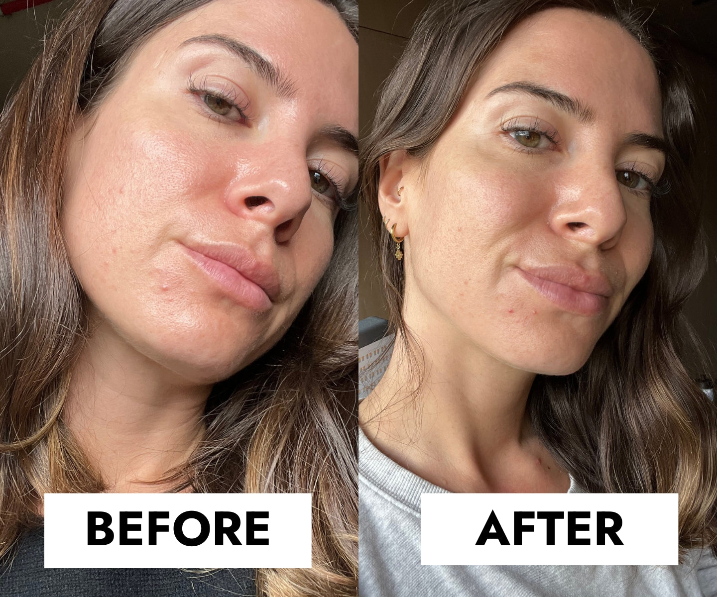 Blemish Control Gel | For clear, blemish-free skin